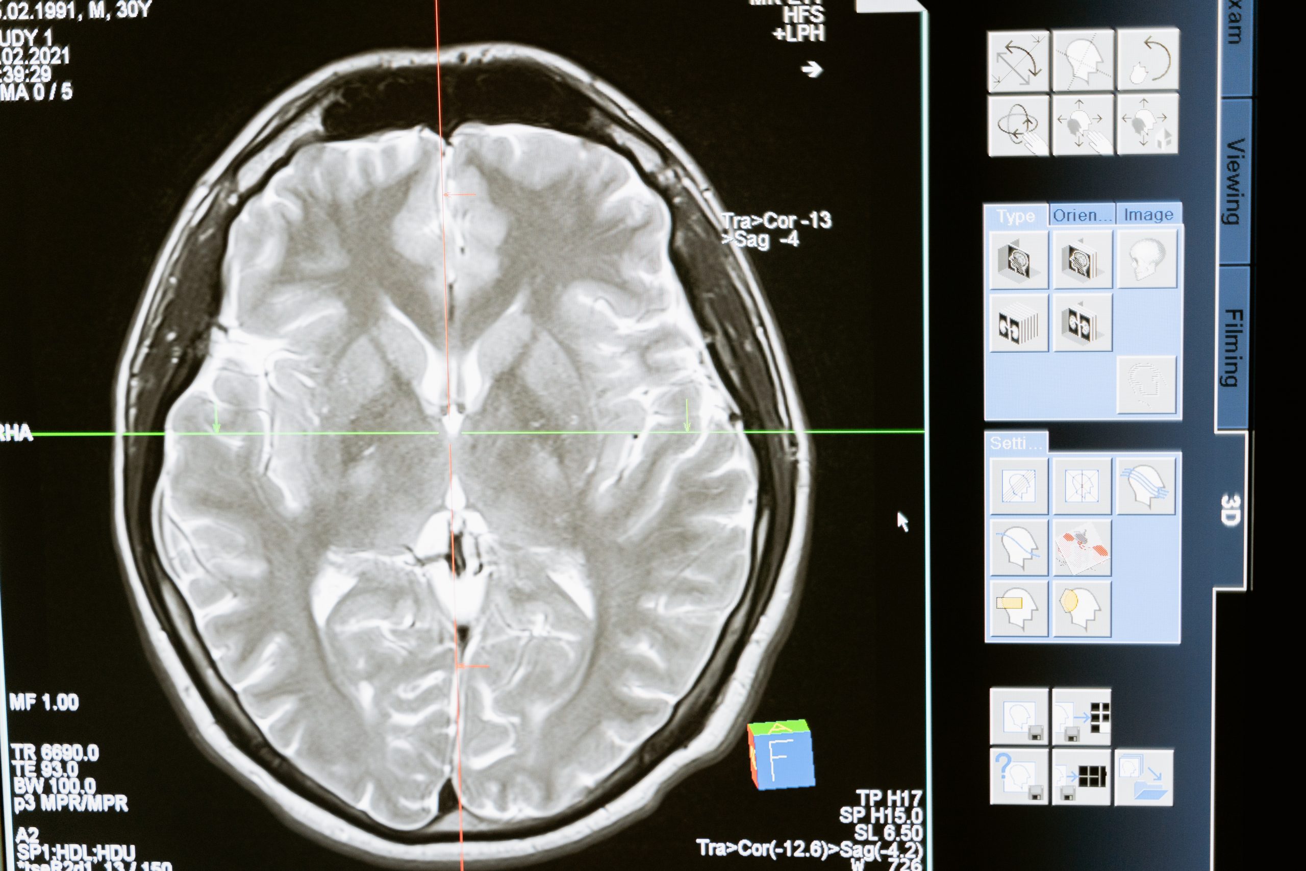 Psilocybin for Traumatic Brain Injury (TBI)